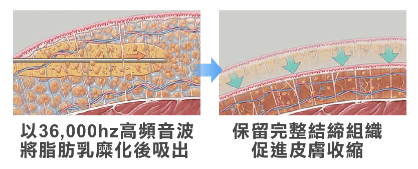 威塑抽脂, vaser, 乳糜化, 保留結締組織