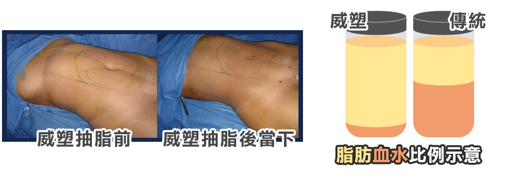 威塑抽脂和傳統抽脂手術的脂肪血水比例示意圖，威塑抽脂術中比較圖