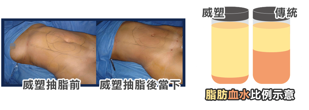 威塑抽脂和傳統抽脂手術的脂肪血水比例示意圖,威塑抽脂術中比較圖