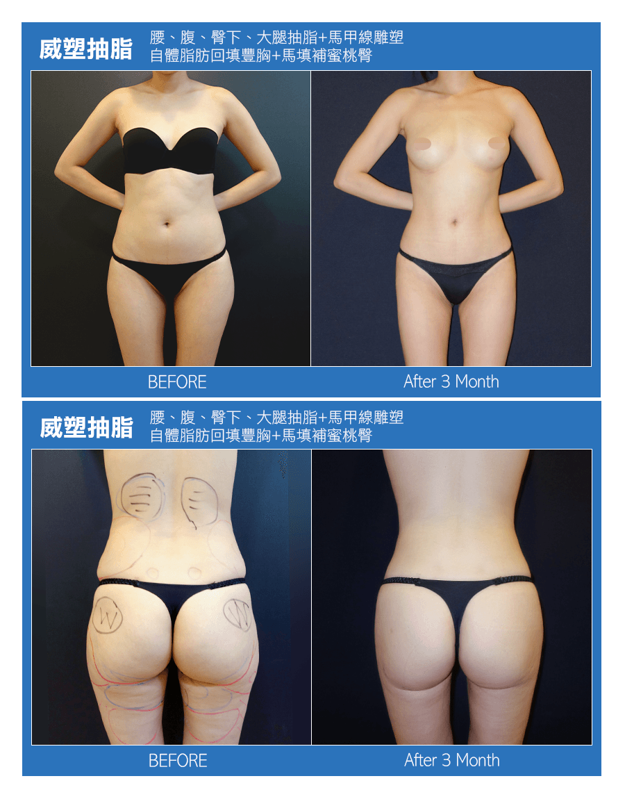 威塑抽脂, vaser, 案例, 自體脂肪補胸, 補臀