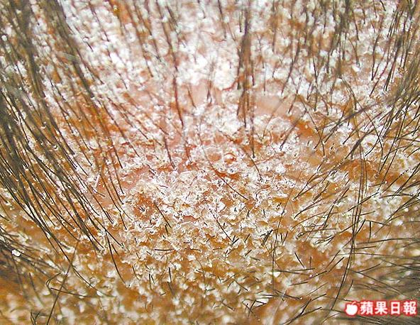 雅丰郭玉玲醫師談頭皮屑困擾，留意換季脂漏性皮膚炎