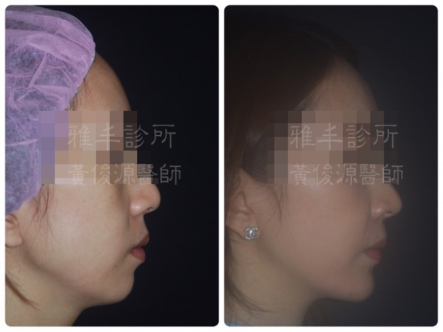 【黃俊源醫師】改善嘴凸與下巴後縮 類正顎手術讓下半臉比例更和諧 
