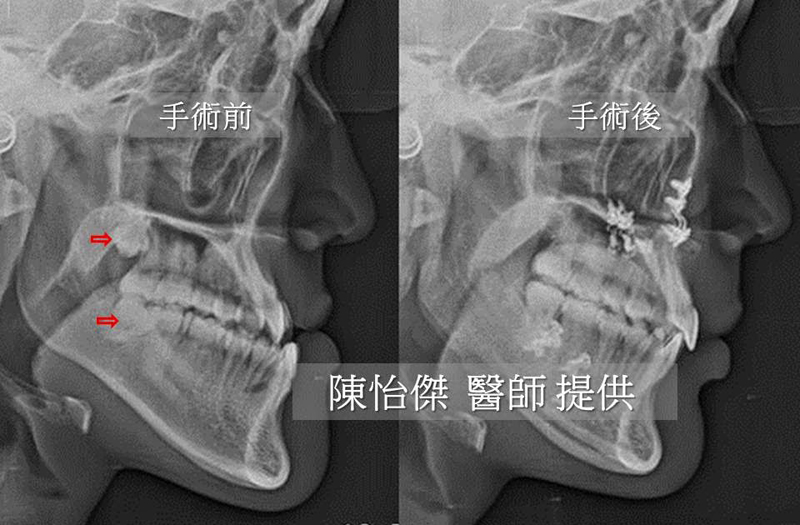 正顎,陳怡傑醫師,長庚正顎,正顎手術,削骨,雅丰