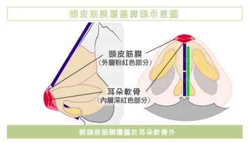 二次隆鼻重建術 03