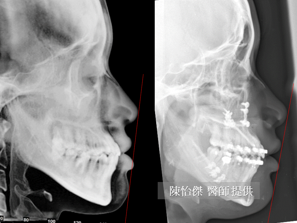 正顎,陳怡傑醫師,長庚正顎,正顎手術,削骨,雅丰