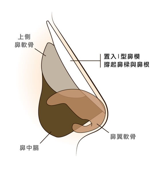 【曾文尚醫師】隆鼻專家談傳統隆鼻與結構式隆鼻的差異02