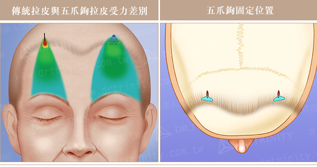 【曾文尚醫師】上臉鬆弛顯蒼老 前額提眉內視鏡拉皮從整體著手改善