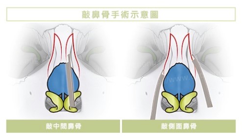 雅丰曾文尚隆鼻－敲鼻骨