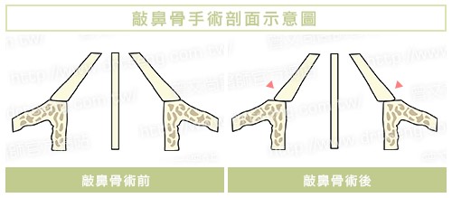 雅丰曾文尚隆鼻－敲鼻骨手術