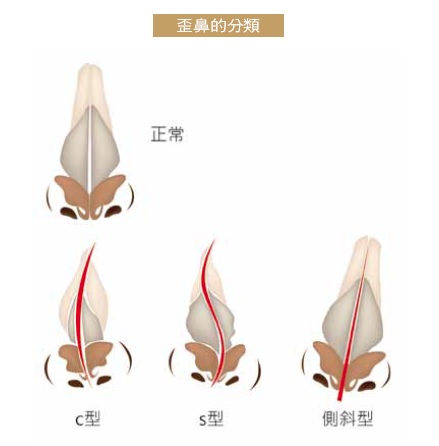 【黃俊源醫師】結構式隆鼻 矯正歪鼻困擾