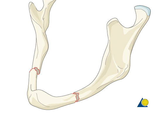 下顎骨骨折示意圖,雅丰陳怡傑醫師