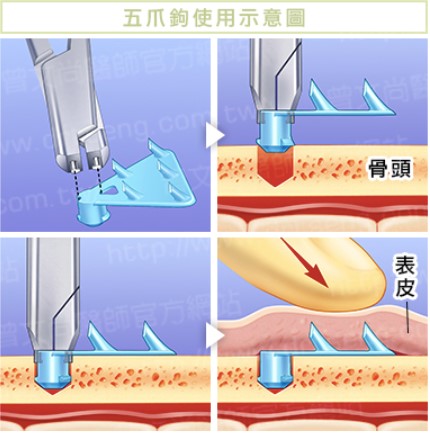 雅丰診所-前額提眉拉提手術