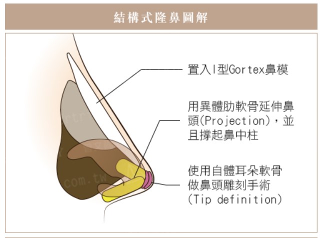 雅丰-結構式隆鼻圖解