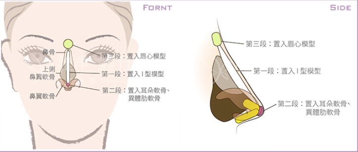 結構式隆鼻客製化訂製開運鼻型 曾文尚醫師