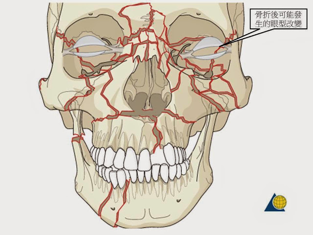 從顴骨骨折的治療觀點談顴骨削骨手術,正顎推薦