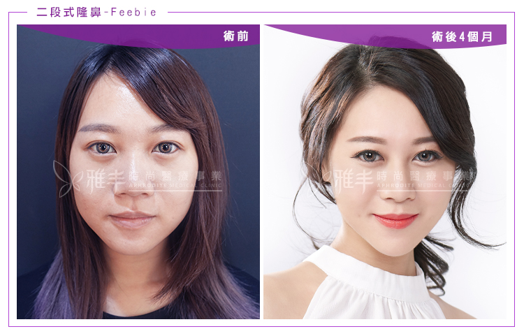Feebie隆鼻術後四個月
