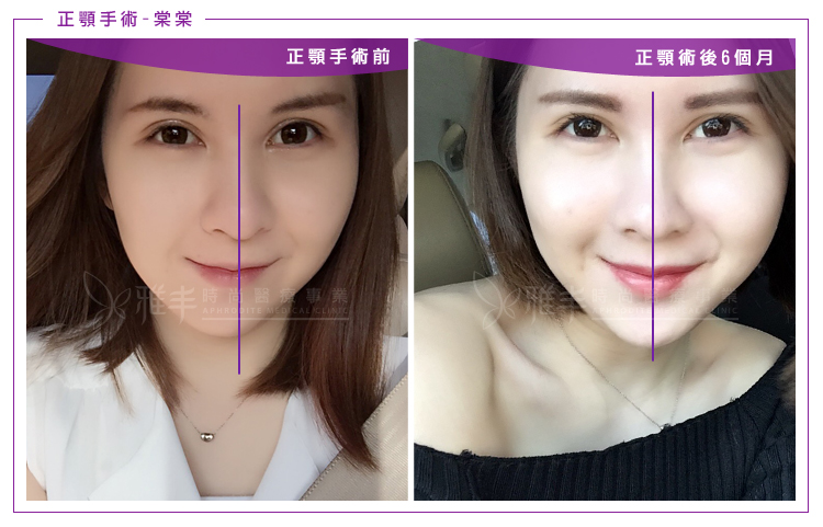雅丰,陳怡傑醫師,正顎手術,歪臉,下巴後縮