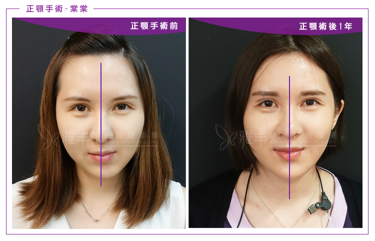 雅丰,陳怡傑醫師,正顎手術,歪臉,下巴後縮