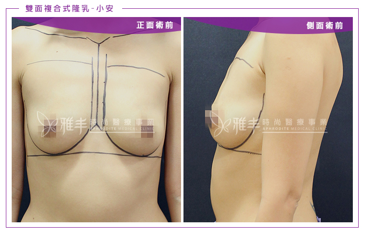 雙面複合式隆乳術前手術照,雅丰林孟羲醫師