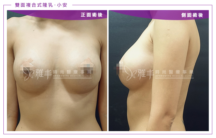 雙面複合式隆乳術後手術照正面側面,雅丰林孟羲醫師