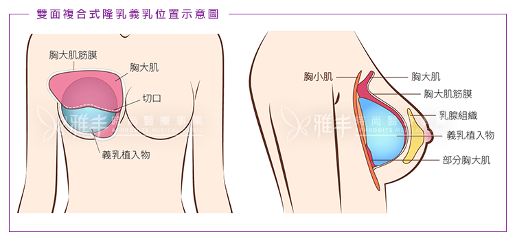 雙面複合式隆乳手術圖解,隆乳推薦,雅丰麗緻診所,林孟羲醫師