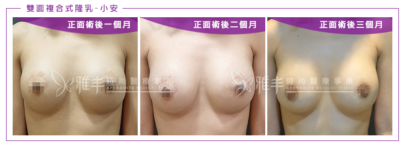 雙面複合式隆乳手術術後一到三個月正面照,自然隆乳,林孟羲醫師