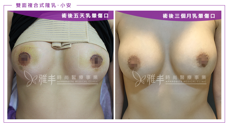 雙面複合式隆乳手術術後三個月照,綁胸帶,林孟羲醫師