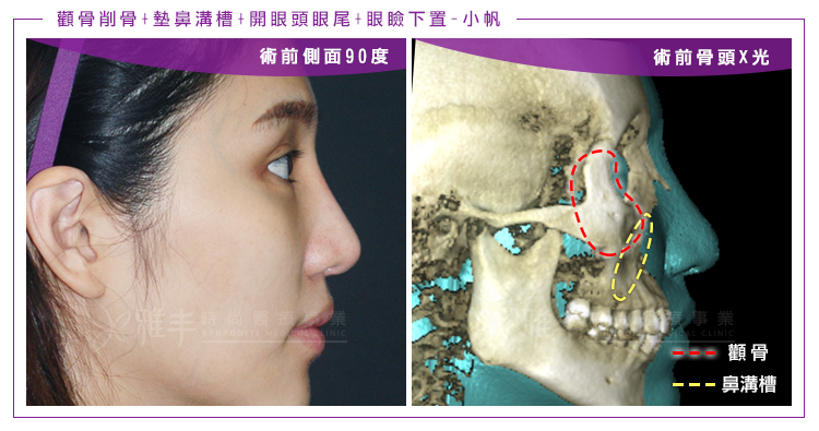 削骨鼻唇溝側面90度術前CT