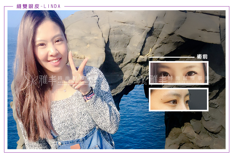 縫雙眼皮術前術後比較