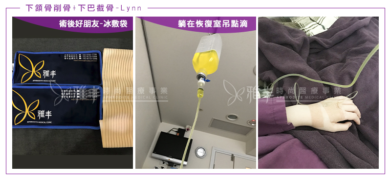 Lynn削骨下巴截骨術後第1天返診