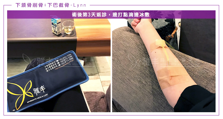 Lynn削骨下巴截骨術後第3天返診