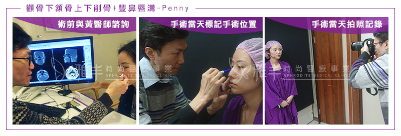 Penny削骨鼻唇溝術前諮詢