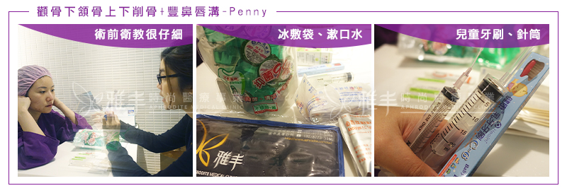 Penny削骨鼻唇溝手術當天