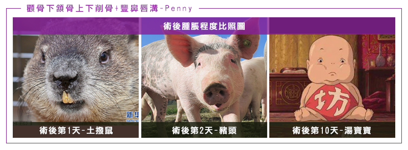 Penny削骨鼻唇溝術後腫脹感