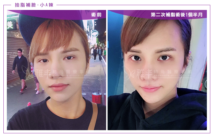 小A辣第2次抽脂補臉術後1個半月02