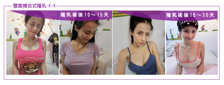 隆乳心得kiki隆乳術後10-30天