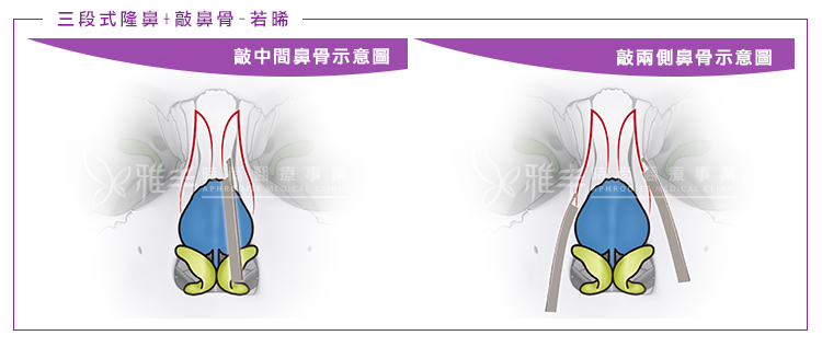 敲鼻骨手術示意圖