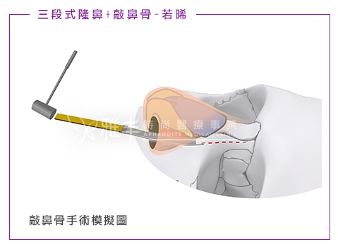 敲鼻骨手術模擬圖