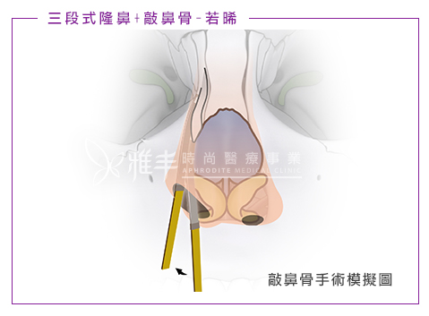 敲鼻骨手術模擬圖2