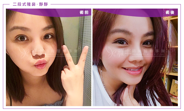 隆鼻術前術後比對