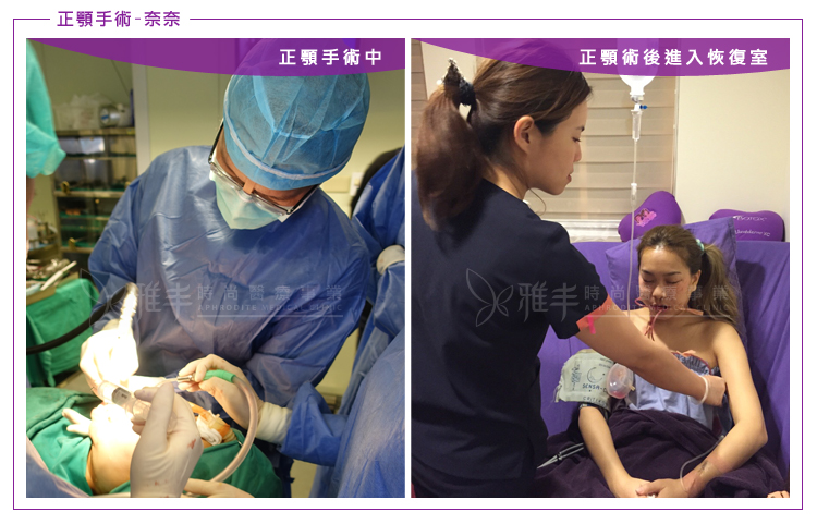 陳怡傑醫師雅丰案例奈奈正顎矯正歪臉+眼袋手術中