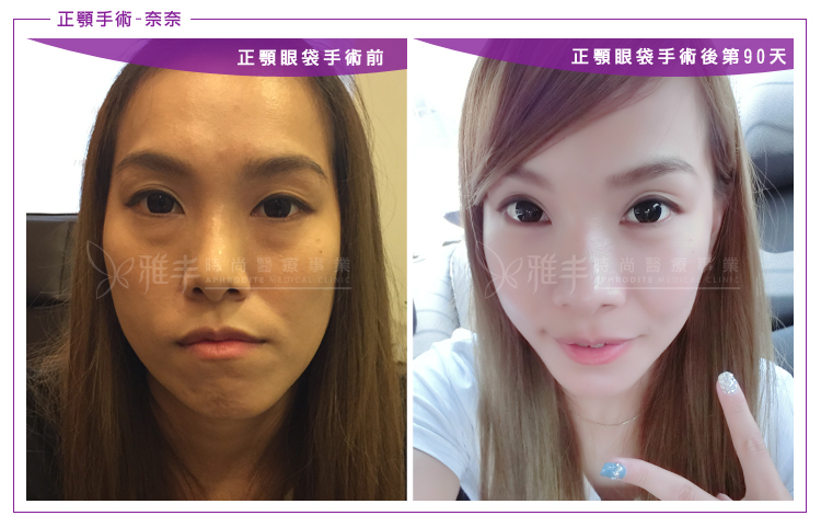 陳怡傑案例奈奈正顎矯正歪臉+眼袋手術術後90天