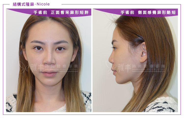 nicole結構式隆鼻術前