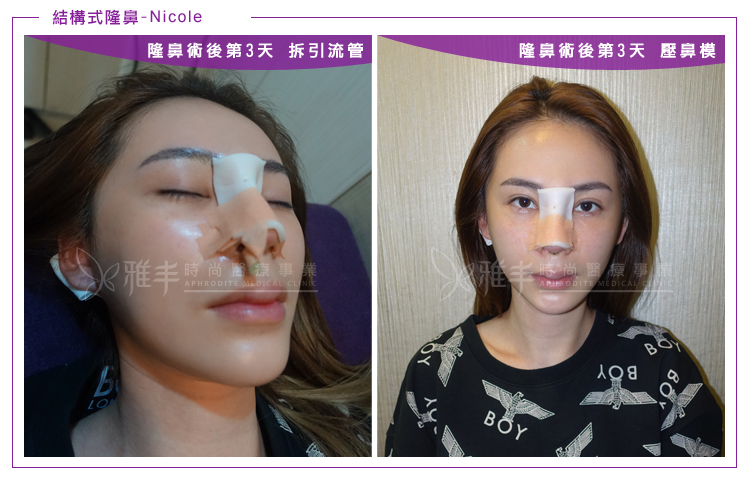 nicole結構式隆鼻術後第三天拆引流管壓鼻模