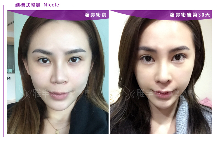 nicole結構式隆鼻術後滿月前後比對