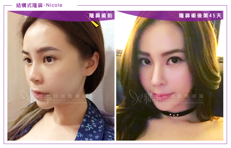 nicole結構式隆鼻術後45天,曾文尚