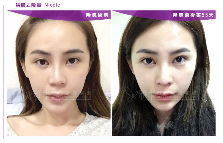 nicole結構式隆鼻術後55天,曾文尚