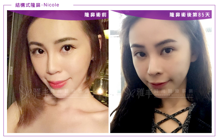 nicole結構式隆鼻術後85天,曾文尚