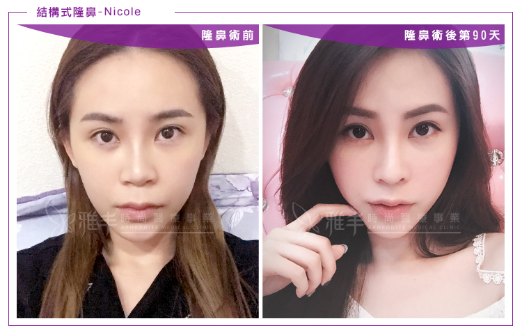 nicole結構式隆鼻術後180天,曾文尚