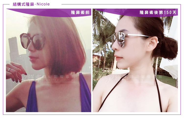 nicole結構式隆鼻術後150天,曾文尚